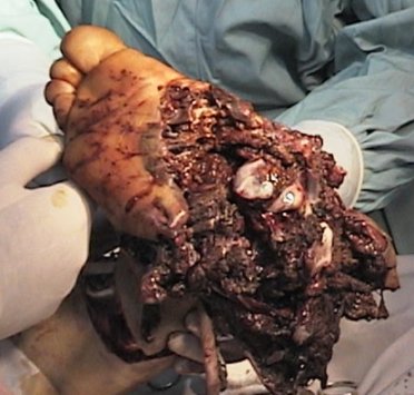 blast wrecked foot