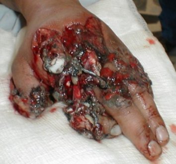picture of blast wrecked hand